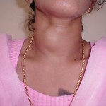 Goitre Images