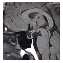 pituitary-9