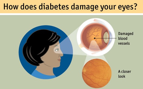 diabetes damage your eye
