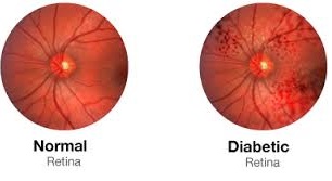 normal diabetic retina