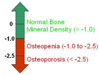 Normal Bone Mineral Density. Osteoporosis, Osteopenia