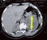 CT scan showing tumour of Lt Adrenal Gland