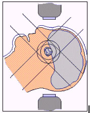 pituitary tumor radiotherapy