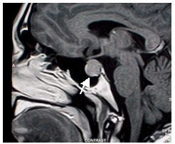 Pituitary - MR scan of Prolactinoma
