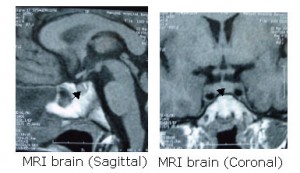 Pituitary gland - MR scan of the brain