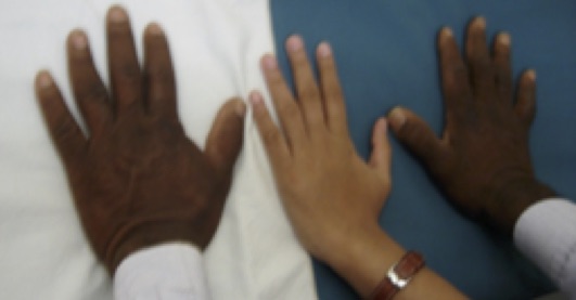 Picture showing hands of a patient, middle one is of a Doctor
