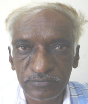 Photograph of a patient with Acromegaly