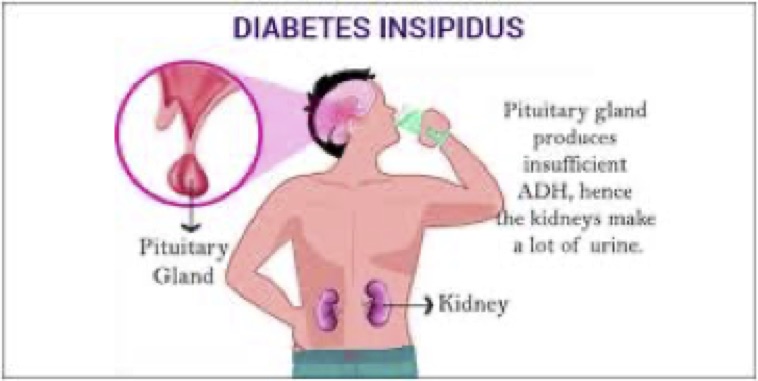 diabetes insipidus