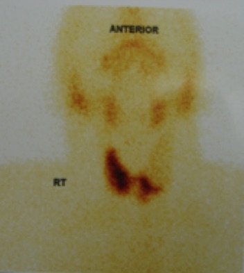 Cold nodule with decreased uptake in the left upper lobe