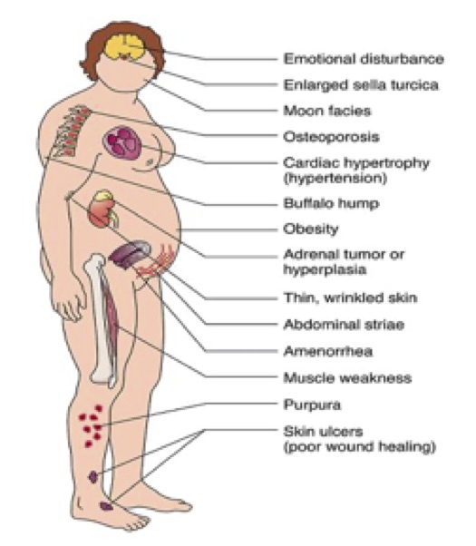 Cusing's Syndrome