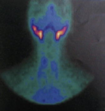 Decreased uptake Thyroiditis