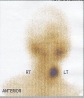 Hot nodule with increased uptake in the left lobe