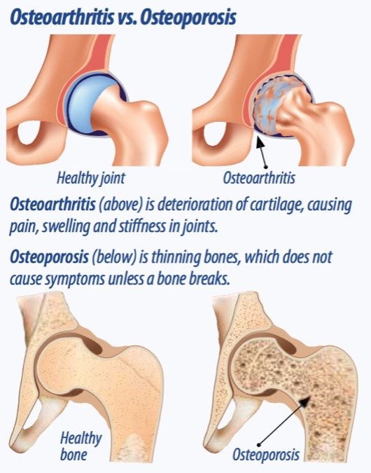 Osteoarthritis vs. Osteoporosis. Image credit arthritis-advisor.com