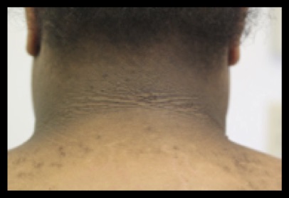 Acanthosis Nigricans in Neck