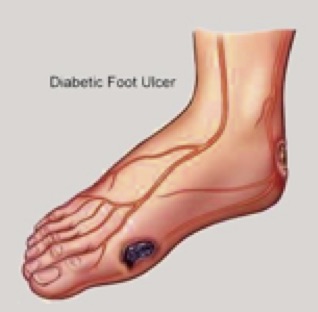 Diabetic Foot Ulcer