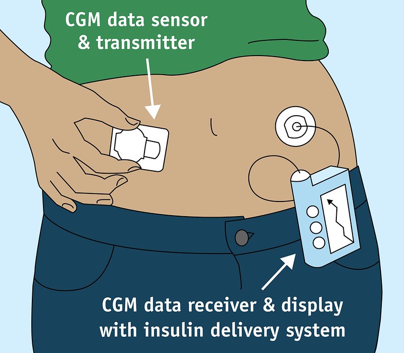 Continuous Glucose Monitor. Image Credit U.S. Food and Drug Administration www.flickr.com/people/fdaphotos/