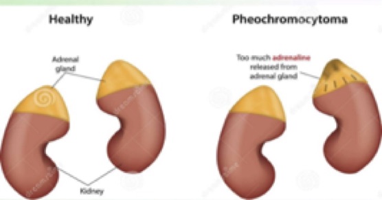 healthy Phaeochromocytoma