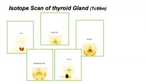 Isotope Scan of Thyroid Gland