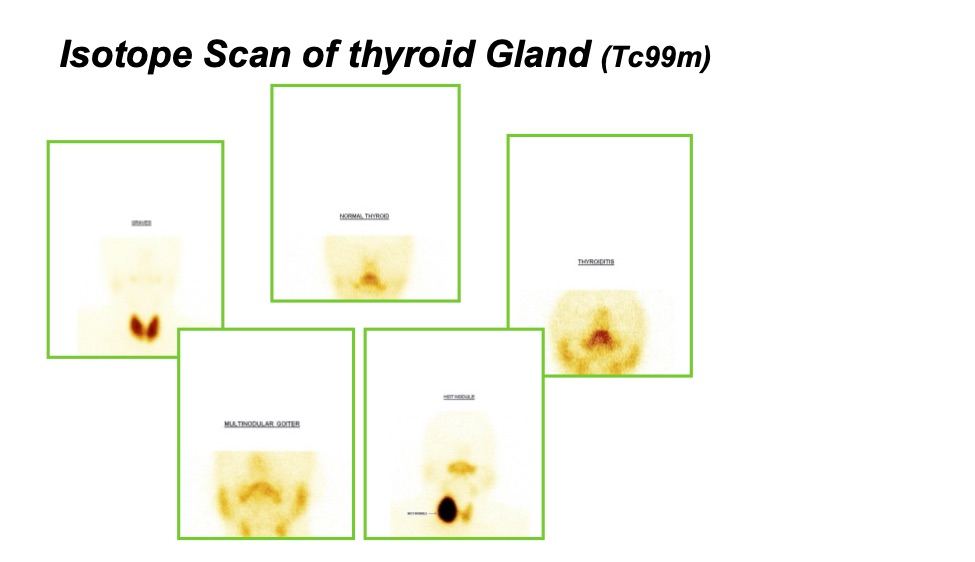 Isotope Scan of Thyroid Gland