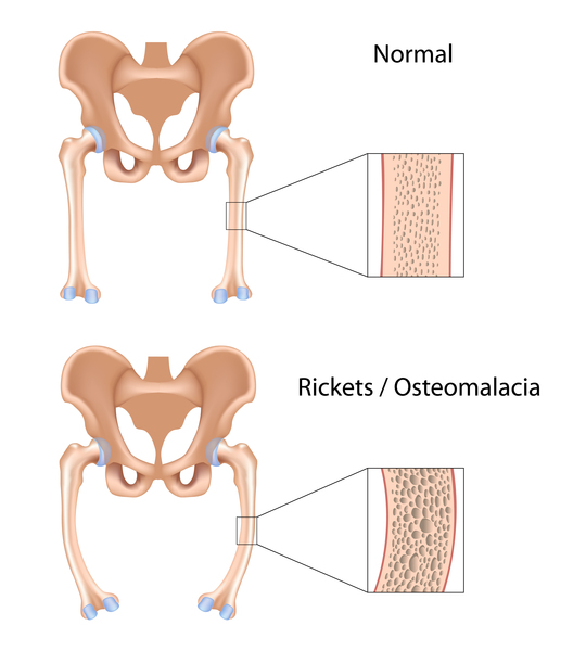 Rickets Osteomalacia. Image Credit nih.gov