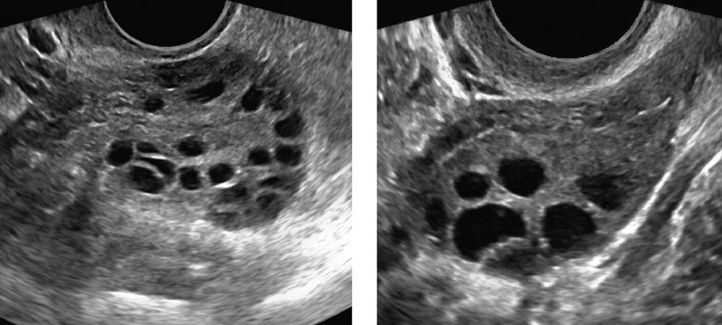 Ultrasound showing Polycystic Ovaries