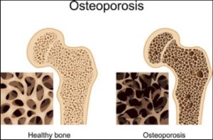 healthy bone and osteoporosis