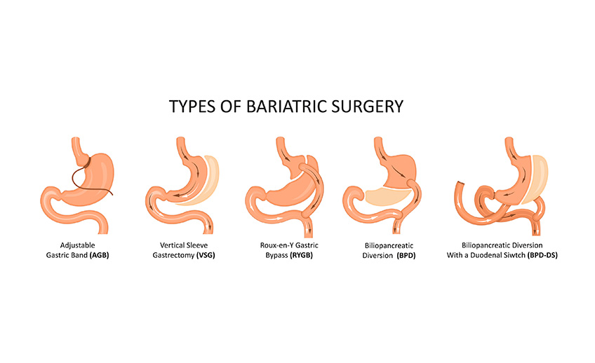 types of bariatric surgery diagram. Image source https://doctorbariatric.com/