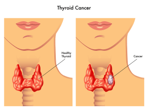 Thyroid Cancer